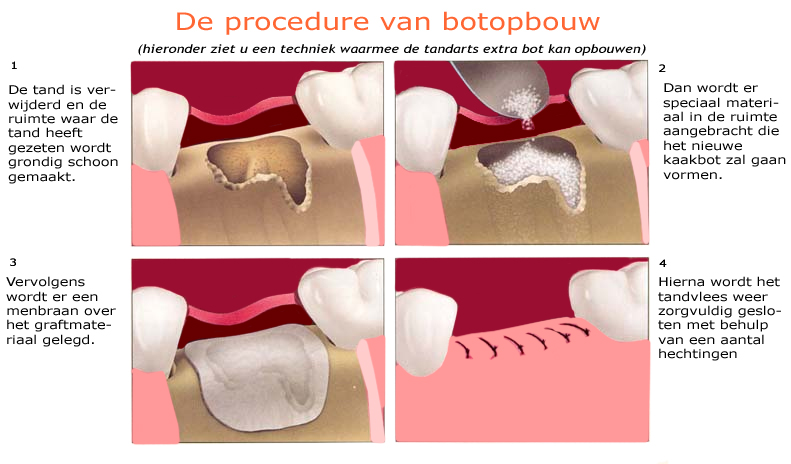 Schema botopbouw