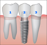 Implantaten